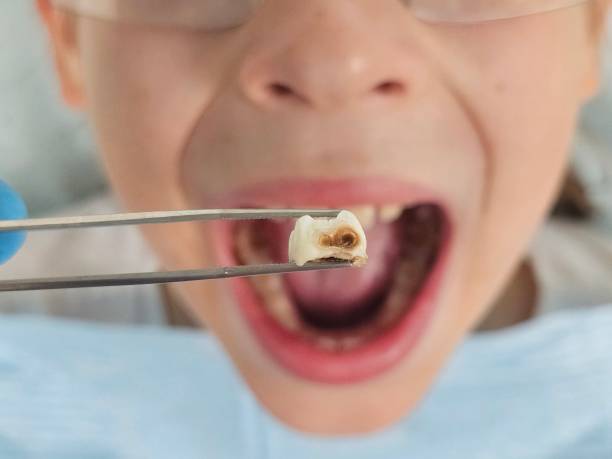 Best Dentist for Tooth Abscess  in Detroit Beach, MI